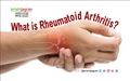 Rheumatoid Arthritis: Early Signs, Symptoms & Treatment