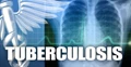 Tuberculosis (TB): What are the Symptoms, Causes, Risk Factors and Treatment?