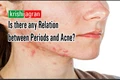 Periods and Acne: Are They Related ?