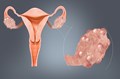 Easy Diet & Lifestyle Changes for Managing Polycystic Ovary Syndrome