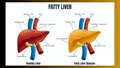 Fatty Liver Symptoms: 10 Habits Causing Liver Damage Other Than Alcoholism