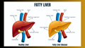 Fatty Liver Symptoms: 10 Habits Causing Liver Damage Other Than Alcoholism