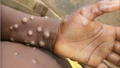 Mpox Outbreak Escalates as WHO Considers Global Health Emergency Amid Surge in Africa