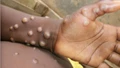 WHO Declares Mpox Outbreak in Africa a Global Public Health Emergency